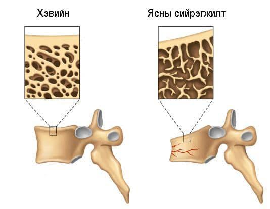 Ясны сийрэгжилтийн талаар